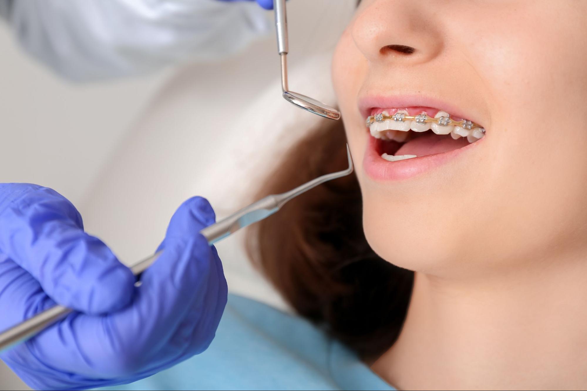 Choosing Between Metal and Clear Braces